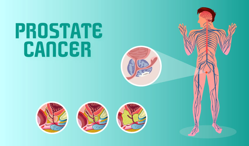 Basics of Prostate Cancer with Symptoms and Prevention